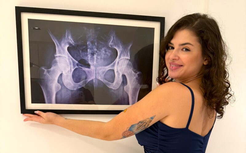 Brazilian influencer Kerolay Chaves, 24, framed an X-ray of her butt to prove her curves are natural, silencing surgery rumors ahead of the Miss BumBum 2025 pageant.