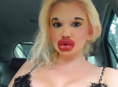 Influencer known for the world’s biggest lips says she was rejected by The Bachelor because of her extreme look and now hopes to find love with someone who accepts her fully.