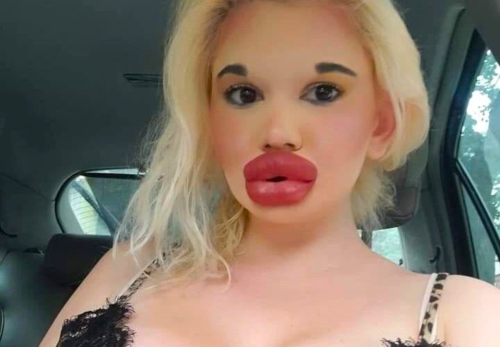 Influencer known for the world’s biggest lips says she was rejected by The Bachelor because of her extreme look and now hopes to find love with someone who accepts her fully.