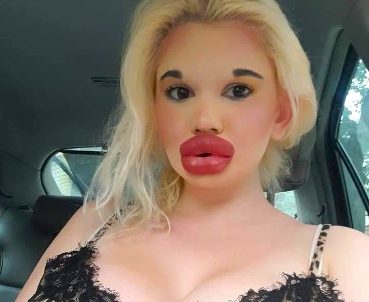 Influencer known for the world’s biggest lips says she was rejected by The Bachelor because of her extreme look and now hopes to find love with someone who accepts her fully.